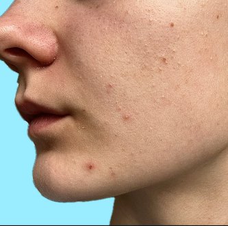 Waarom je juist acne krijgt tijdens de examens (en dit doe je ertegen)
